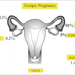 Pregnancy ectopic diagram discriminatory zone fallopian after tubal tubes hcg file ivf uterine pregnant easy commons wikimedia suspected structure fig